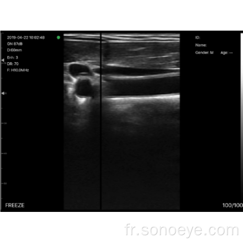 T sonde sans fil biplan du modèle t